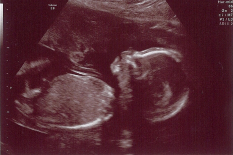 Ecografía de un feto de 20 semanas. | Ambernectar 13 | photopin